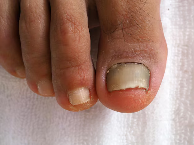 closeup-foot-with-fungus-nails-onycholysis_543222-1998