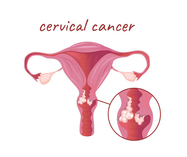 concept-female-anatomy-uterus-cervical-cancer-this-illustration-depicts-flat-vector-cartoon-design_198565-5001