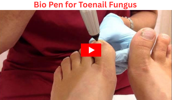 Bio Pen For Toenail Fungus