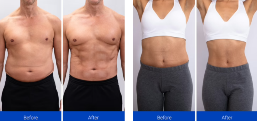 NavaMax Abs Stimulator Before After