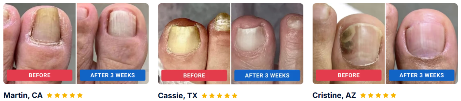 Orivelle Fungus Pen Customer Reviews