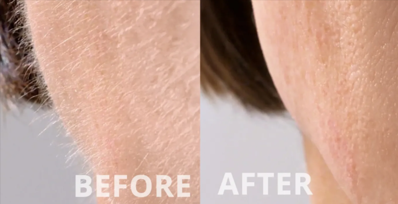 Sonicsmooth Pro+ customer review