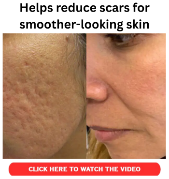 Helps reduce scars for smoother looking skin