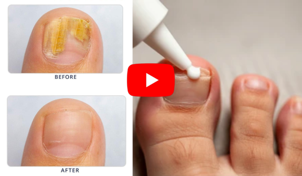7 day nail fungus treatment