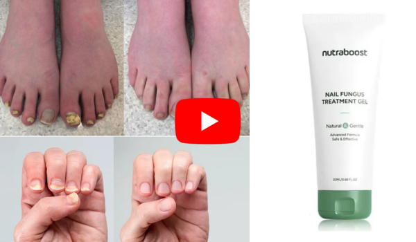 Nutraboost nail fungus treatment gel