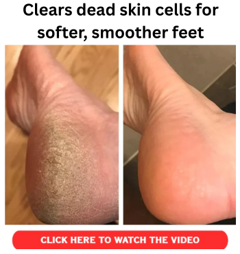 Clears dead skin cells for softer, smoother feet