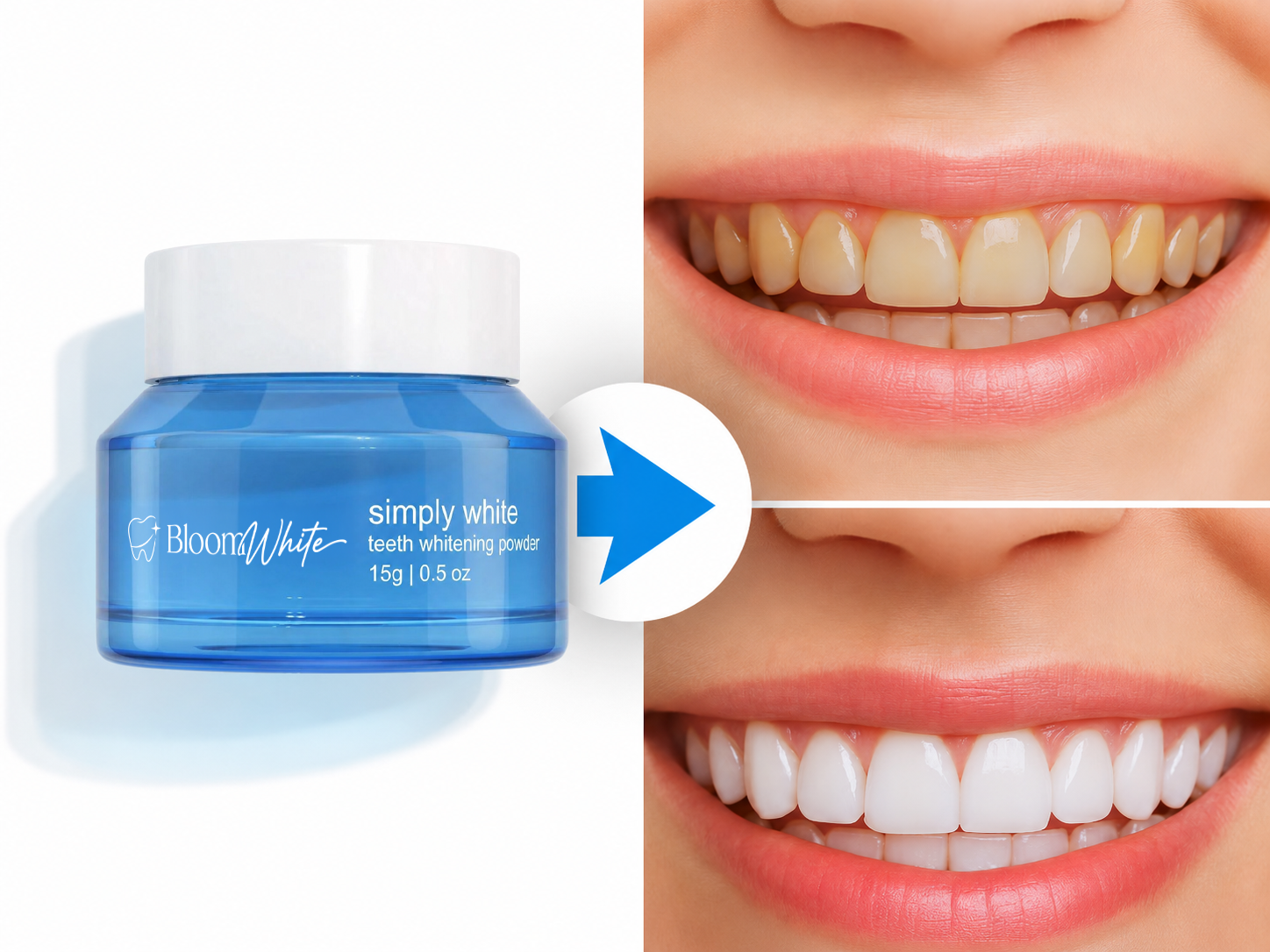 BloomWhite Teeth Whitening befor vs after