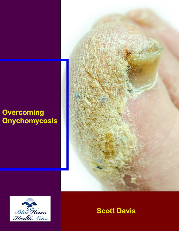 Overcoming Onychomycosis Reviews